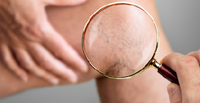 Dores nas pernas: varizes, sedentarismo ou alerta para trombose?